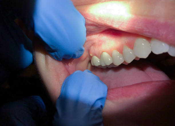 Best Emergency Dental Care for Broken or Chipped Teeth in Crittenden, KY